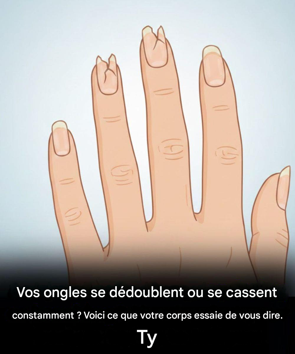 Si vos ongles ressemblent à ça, il est temps de consulter un dentiste.