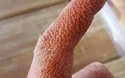 Présentation clinique et prise en charge du syndrome de Sweet : un cas clinique…voir les commentaires
