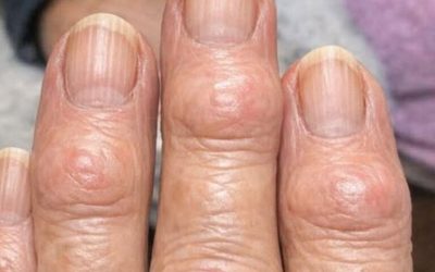 Ma grand-mère a des petites bosses dures qui se forment sur les articulations de ses doigts, près des ongles. Pourquoi cela se propage-t-il ?