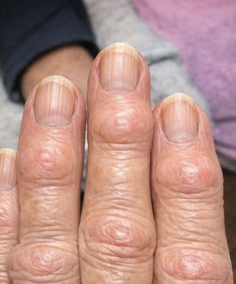 Ma grand-mère a des petites bosses dures qui se forment sur les articulations de ses doigts, près des ongles. Pourquoi cela se propage-t-il ?