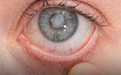 La cataracte : ce que votre médecin ne vous dira pas