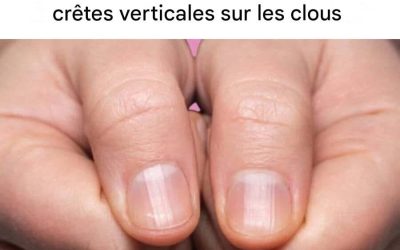 La cause des stries verticales sur les ongles