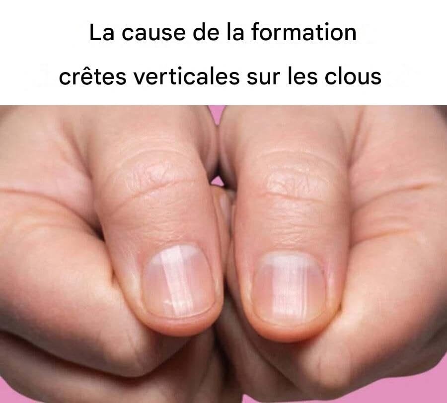 La cause des stries verticales sur les ongles