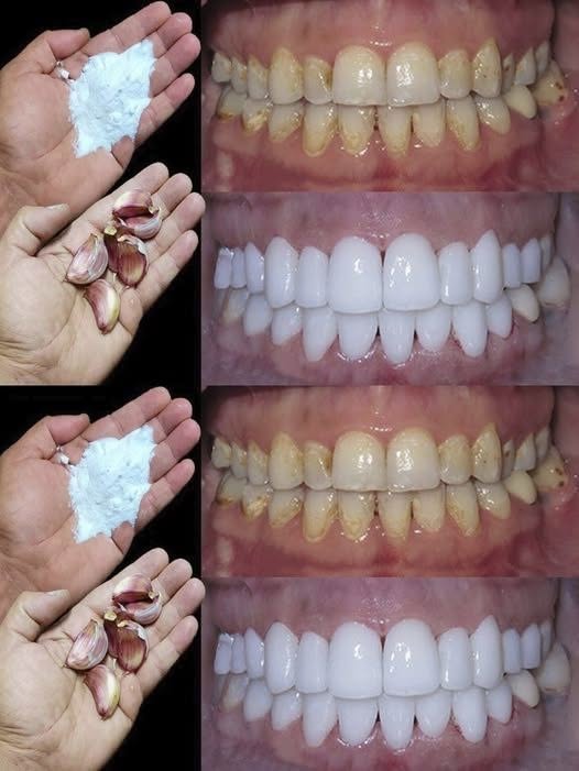 Comment blanchir les dents en 2 minutes?