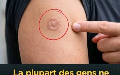 Cicatrice ronde sur votre bras : quelle signification ?