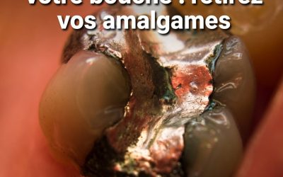 Il y a un tueur dans votre bouche: Retirez vos amalgames pour guérir de nombreuses maladies