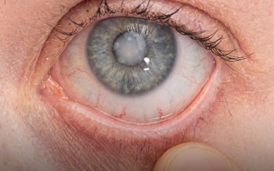La cataracte : ce que votre médecin ne vous dira pas