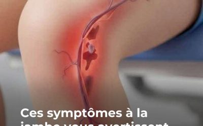 Symptômes qui vous avertissent d’une thrombose sévère…Voir plus