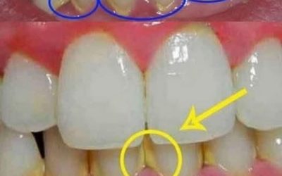 Enlevez la plaque dentaire en 5 minutes naturellement, sans aller chez le dentiste : ce qui fonctionne vraiment