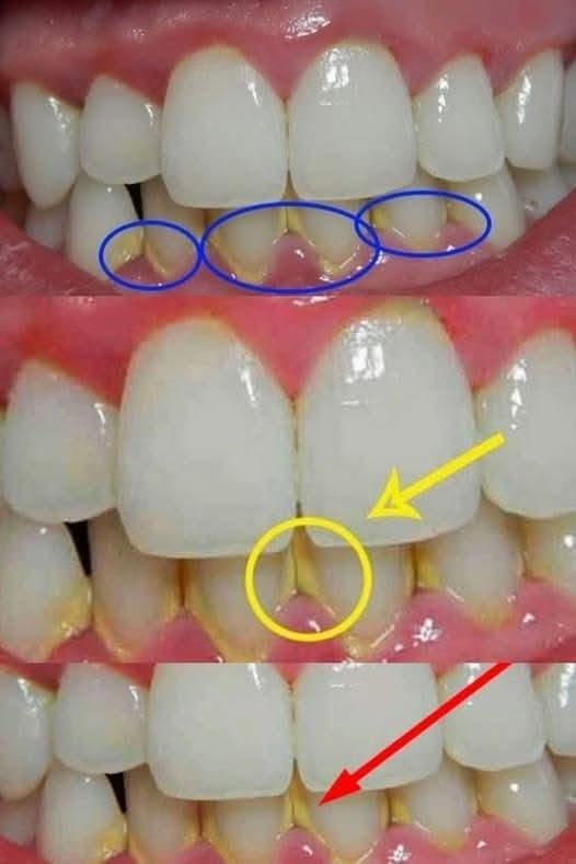 Enlevez la plaque dentaire en 5 minutes naturellement, sans aller chez le dentiste : ce qui fonctionne vraiment