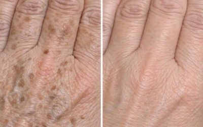 Ma mère m’a appris cette astuce pour atténuer les taches brunes sur mes mains en seulement 3 minutes et sans effort. Voici comment ça marche :