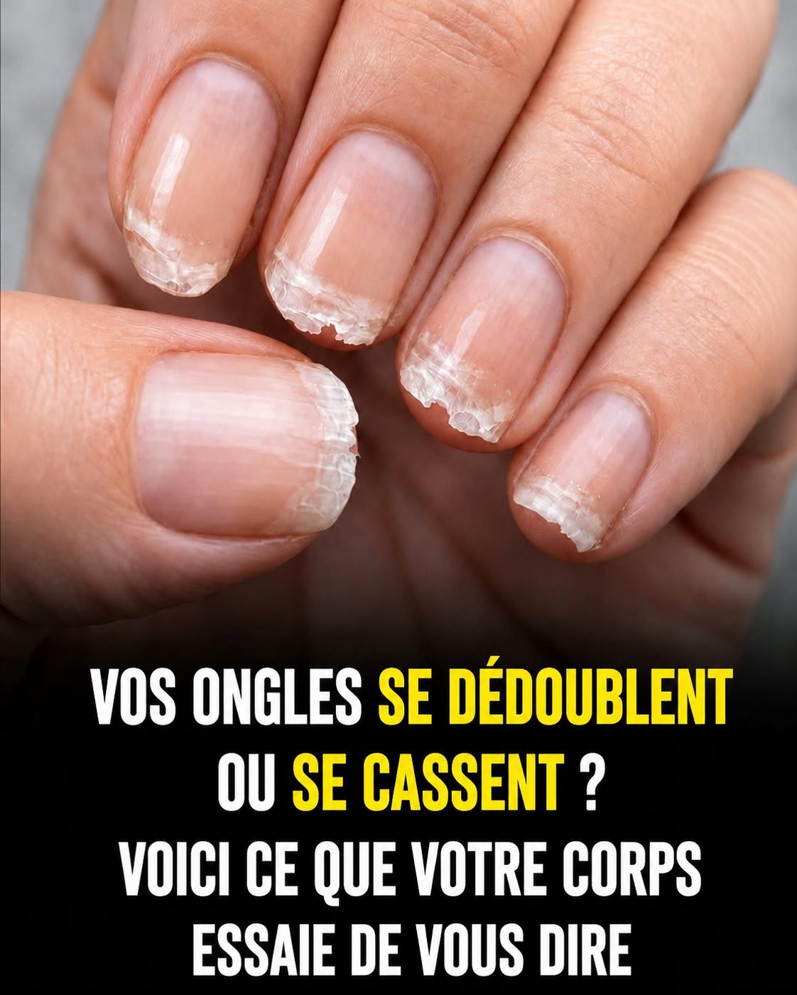 Hérôme est un vernis transparent traitant qui règle le problème en 2 applications , on peut le trouver chez Sephora. Faites l’… En voir plus