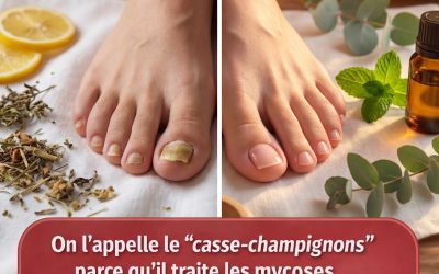 Les clous de girofle pour éliminer les mycoses des ongles et de la peau : remèdes maison efficaces